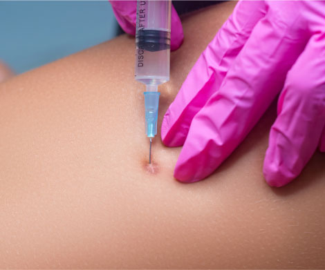 Cortisore Injection Acne & Keloid